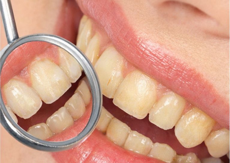 Before professional teeth whitening