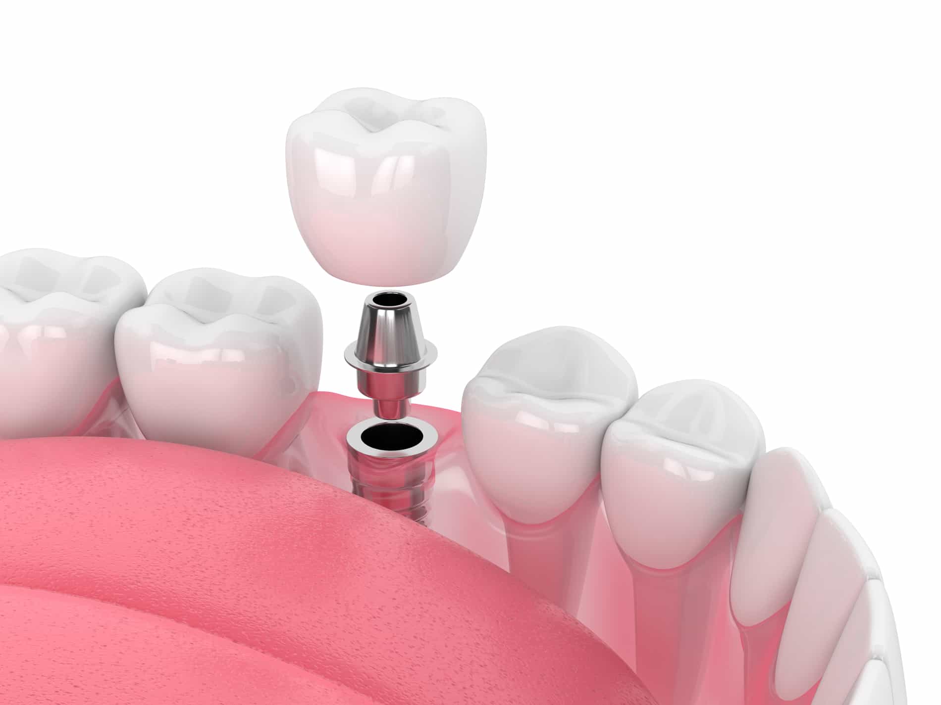 Composite bonding results
